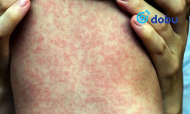 Улаанбурхан өвчний тохиолдол 800 хүрлээ