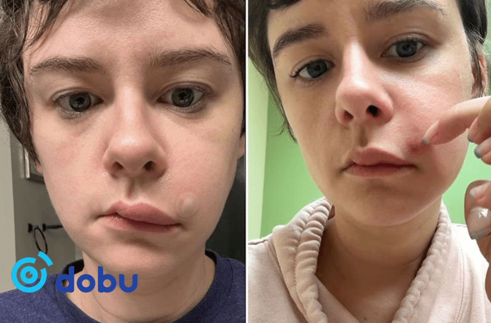 Нүүрэн дээр гарсан БАТГА таныг үхэлд хүргэж болно