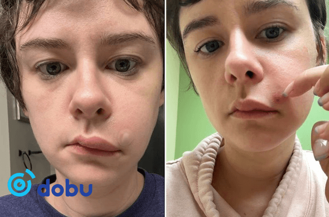 Нүүрэн дээр гарсан БАТГА таныг үхэлд хүргэж болно