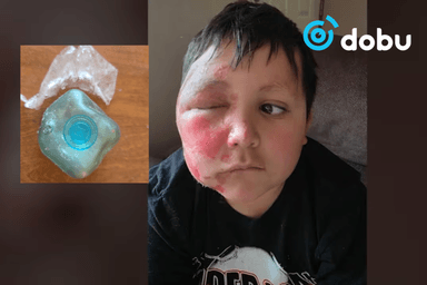 9 настай хүү TikTok трэндийг дуурайж байгаад нүүрэндээ хүнд түлэгдэлт авчээ