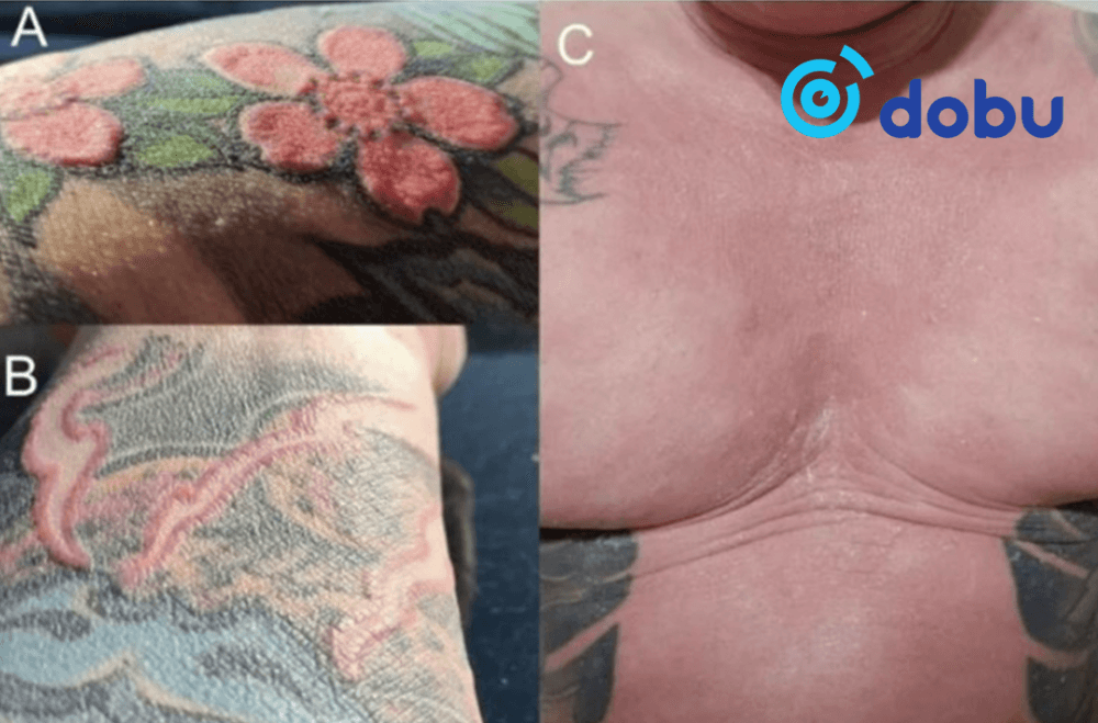 Шивээс хийлгэснээс болж биеийн бүх үс нь унаж, хөлрөх чадвараа алджээ