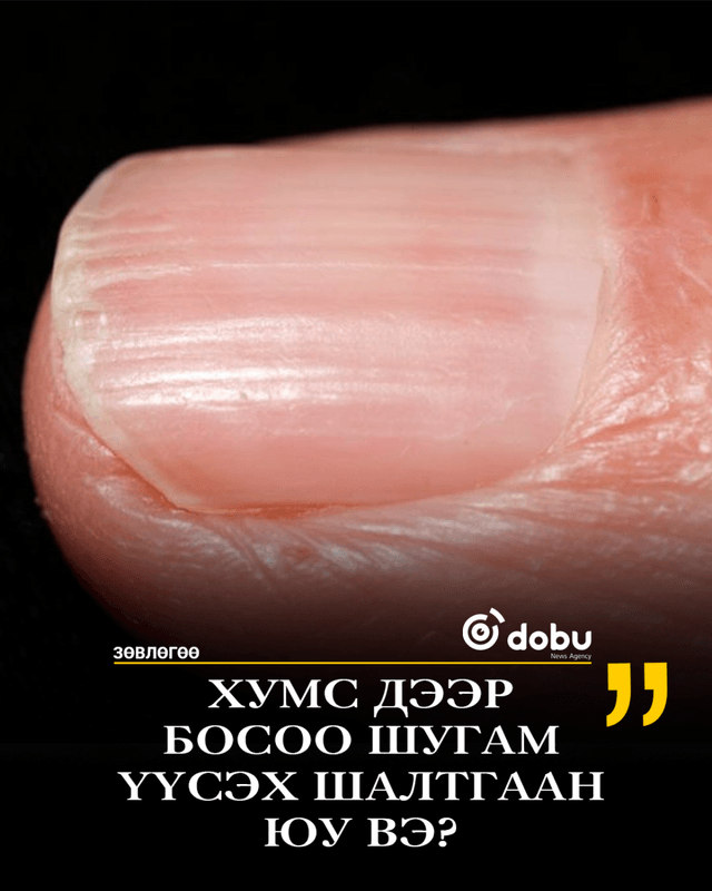 ЗӨВЛӨГӨӨ: Хумс дээр босоо шугам үүсэх шалтгаан