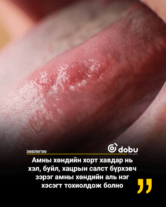 ЗӨВЛӨГӨӨ: Амны хөндийн хорт хавдрын хамгийн чухал эрсдэлт хүчин зүйл бол тамхи татах явдал