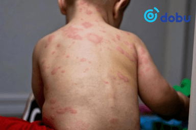 Менингококкт халдварын 5 тохиолдол батлагдаж, нэг хүн нас баржээ