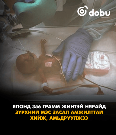 Японд 356 грамм жинтэй нярайд мэс засал хийж, амьдруулжээ