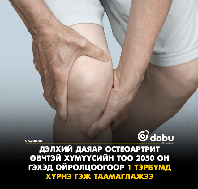 Дэлхий даяар остеоартрит өвчтэй хүмүүсийн тоо 2050 он гэхэд ойролцоогоор 1 тэрбумд хүрнэ гэж таамаглажээ