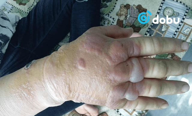 Боом өвчний хүний өвчлөлийн тохиолдол батлагдлаа