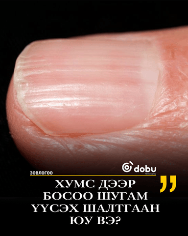ЗӨВЛӨГӨӨ: Хумс дээр босоо шугам үүсэх шалтгаан