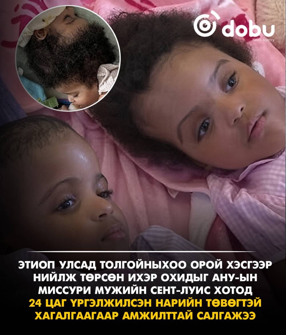 Толгойныхоо орой хэсгээр нийлж төрсөн Этиопын ихэр охидыг 24 цаг үргэлжилсэн нарийн төвөгтэй хагалгаагаар салгажээ